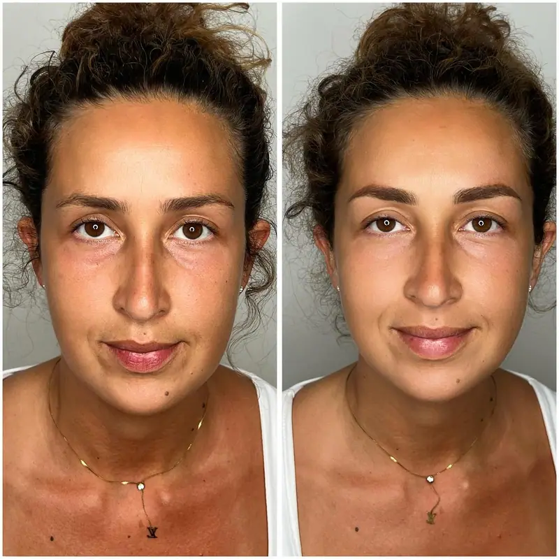 Antes y después del tratamiento